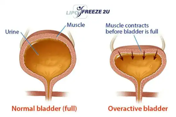 diagram of overactive bladder treatment Uttoxeter