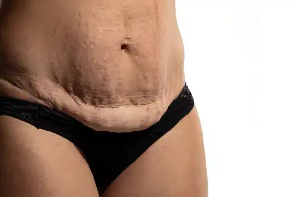 loose skin after weight loss injections Uttoxeter