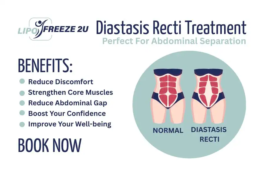 Benefits of body toning treatment Uttoxeter for Diastasis recti