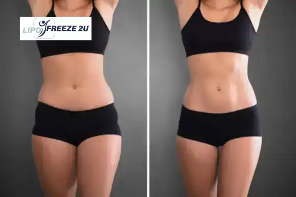 How Can LIPO FREEZE 2U Support Your Post-Pregnancy Body Recovery Uttoxeter?