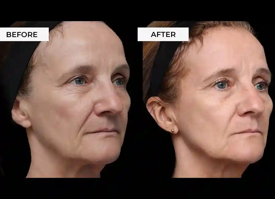 How Many RF Microneedling Sessions Will You Need to See a Difference Uttoxeter?