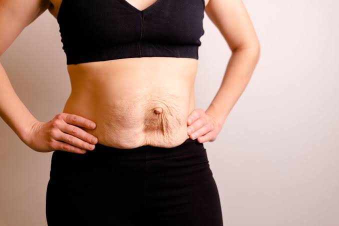 Is Surgery Really the Only Way to Repair Diastasis Recti Uttoxeter?