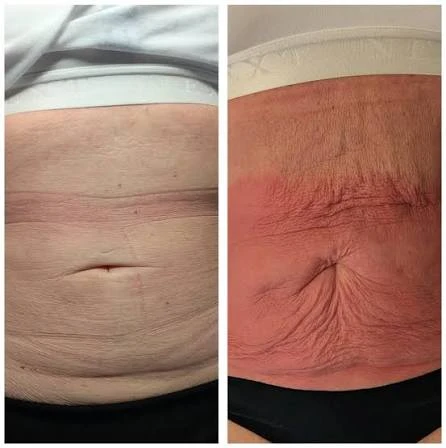 How Does RF Microneedling Improve Crepey, Thin and Uneven Skin Texture Uttoxeter?