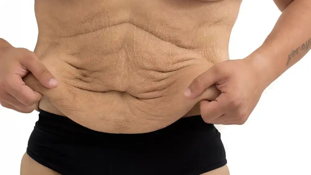 Why Does Weight Loss Medication Leave Some People With Loose or Sagging Skin Uttoxeter?